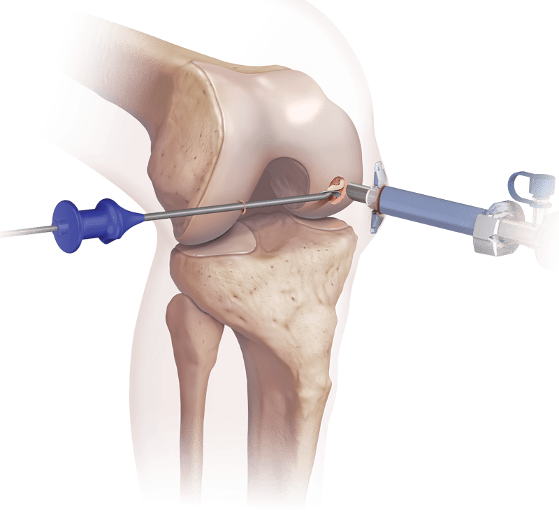 BioCartilage<sup>®</sup> Extracellular Matrix