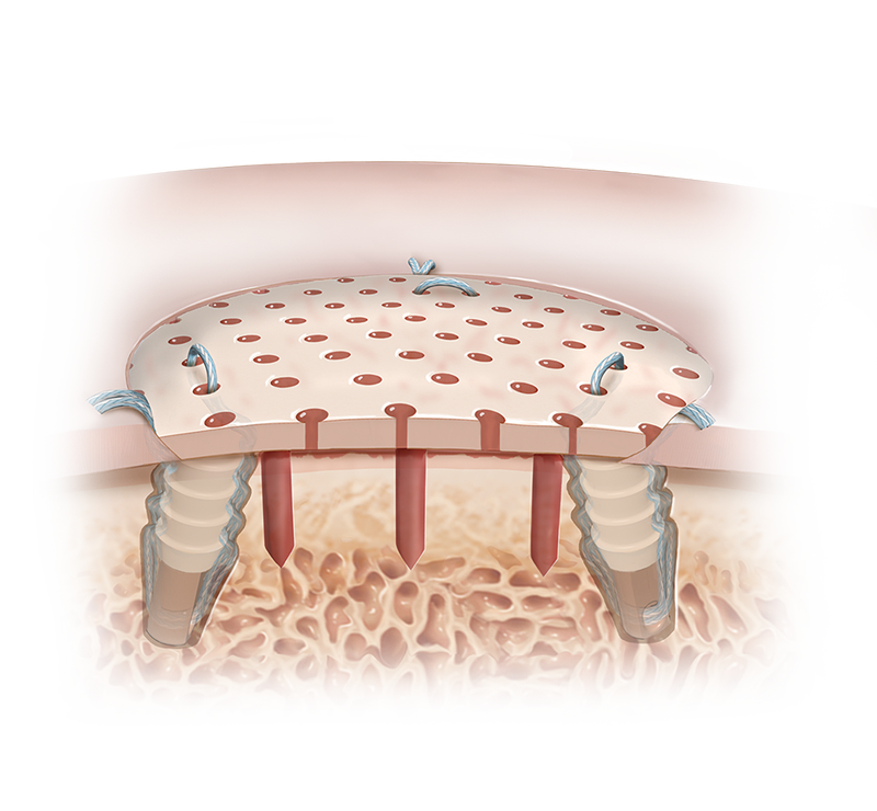 Aloenxerto osteocondral viável Cartiform<sup>®</sup>