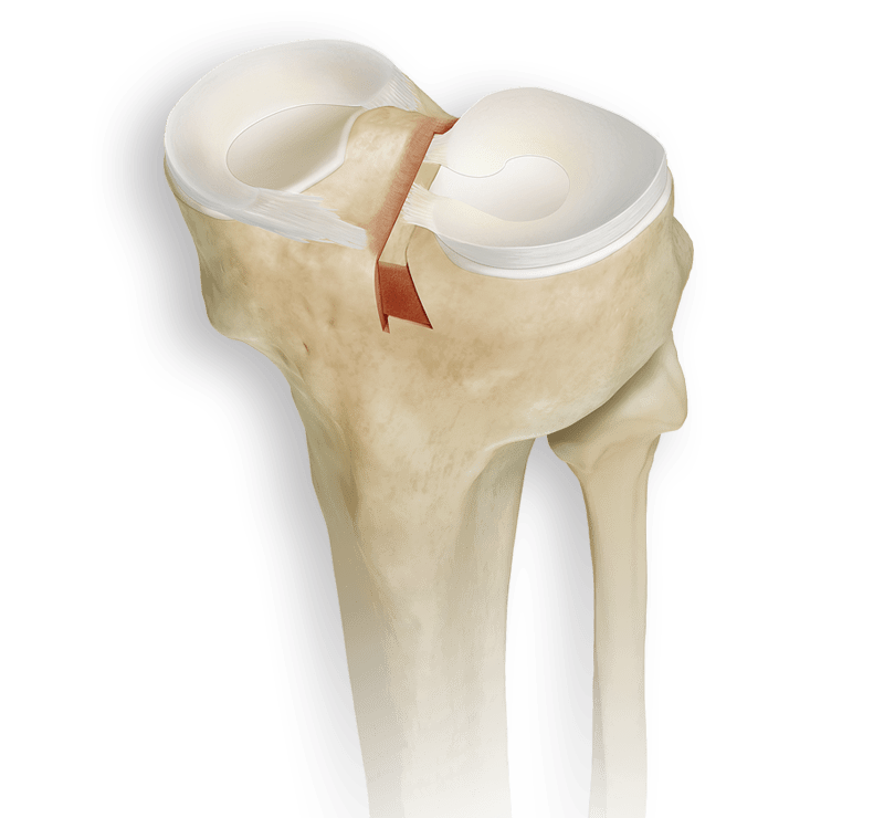 Dovetail Meniscal Allograft Set