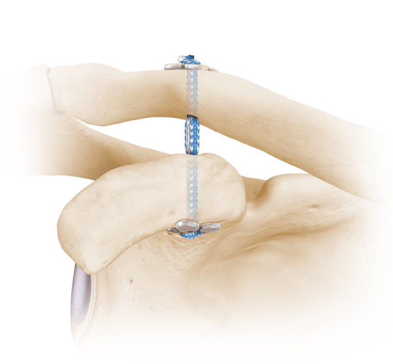 Separação da articulação acromioclavicular