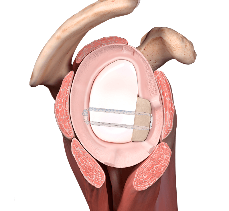 Enxerto ósseo artroscópico sem metal