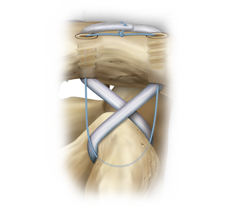 Técnica de reconstrucción de la articulación AC crónica