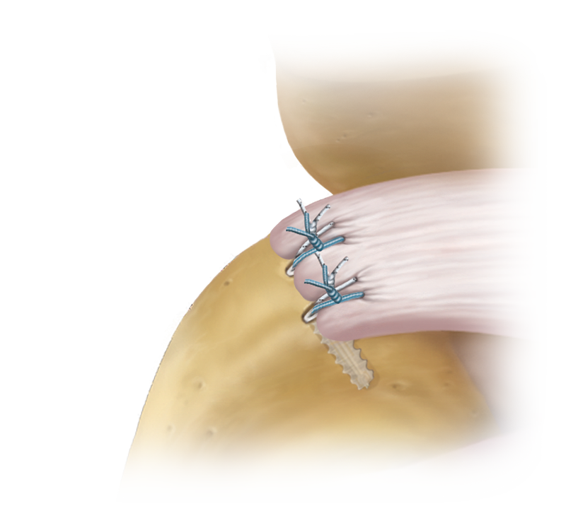 Corkscrew<sup>®</sup> FT Technique