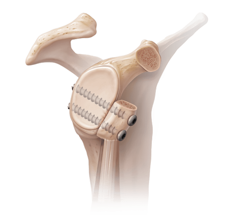 Inestabilidad glenohumeral/ Ruptura del labrum