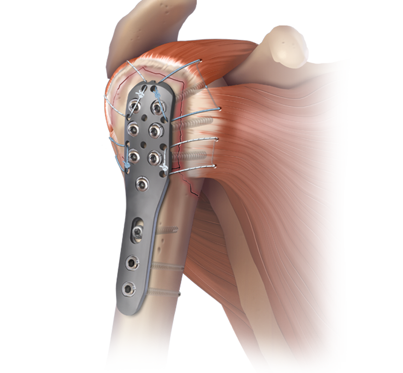 Humeral SuturePlate™-Reparatur