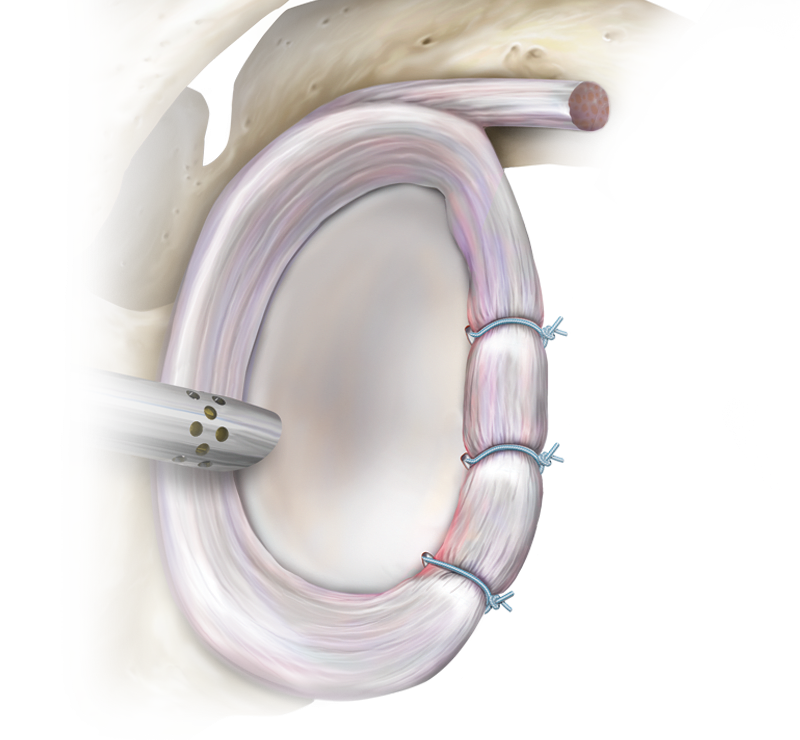 Reparo com nós de lesão labral, ALPSA e HAGL e instabilidade