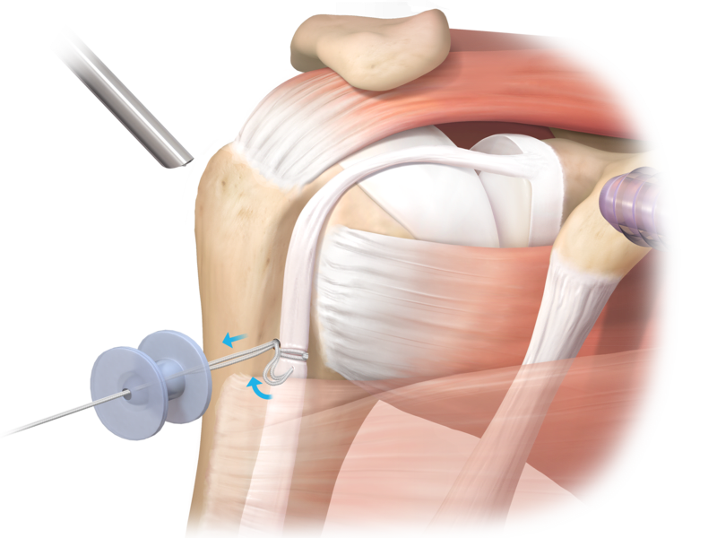 Knotless TensionTight™ Tenodesis Technique