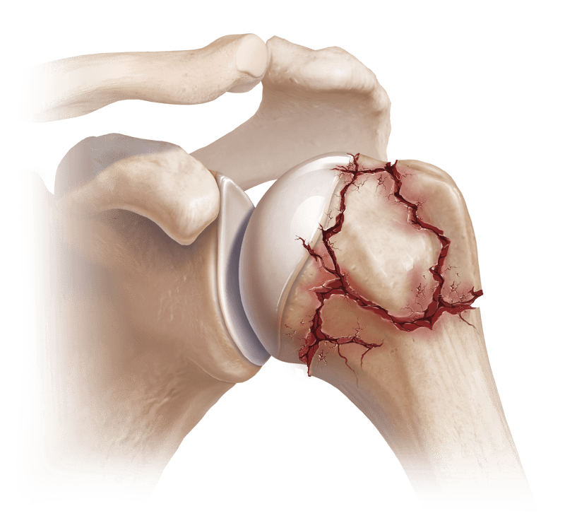 Proximal Humerus Fracture