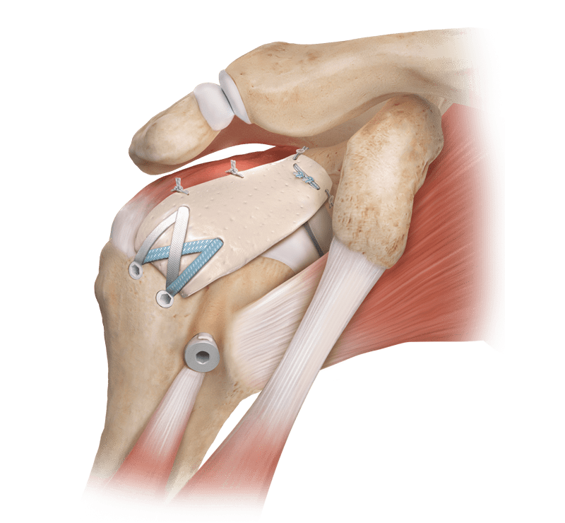 Reconstrucción capsular superior