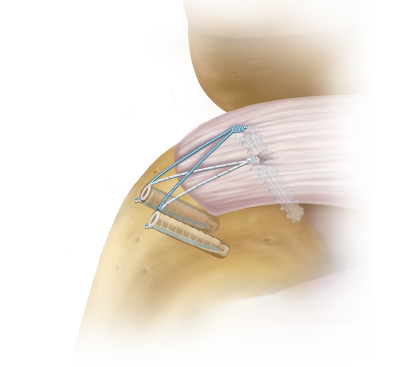 SutureBridge™ Double Row Technique