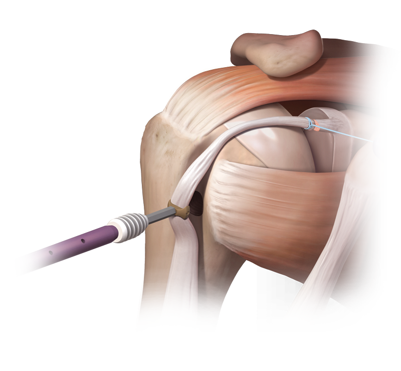 Técnica SwiveLock<sup>®</sup> para tenodesis