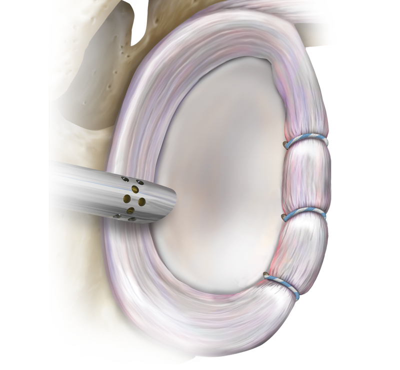 Ancla SutureTak<sup>®</sup> sin nudos