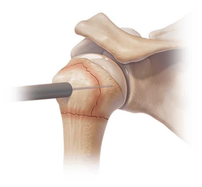 Perforación percutánea