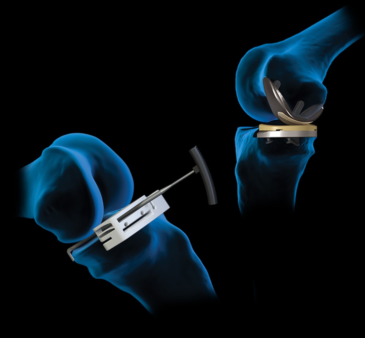 <p>AAOS 2024 Annual Meeting: Knee Arthroplasty Feature Products</p>