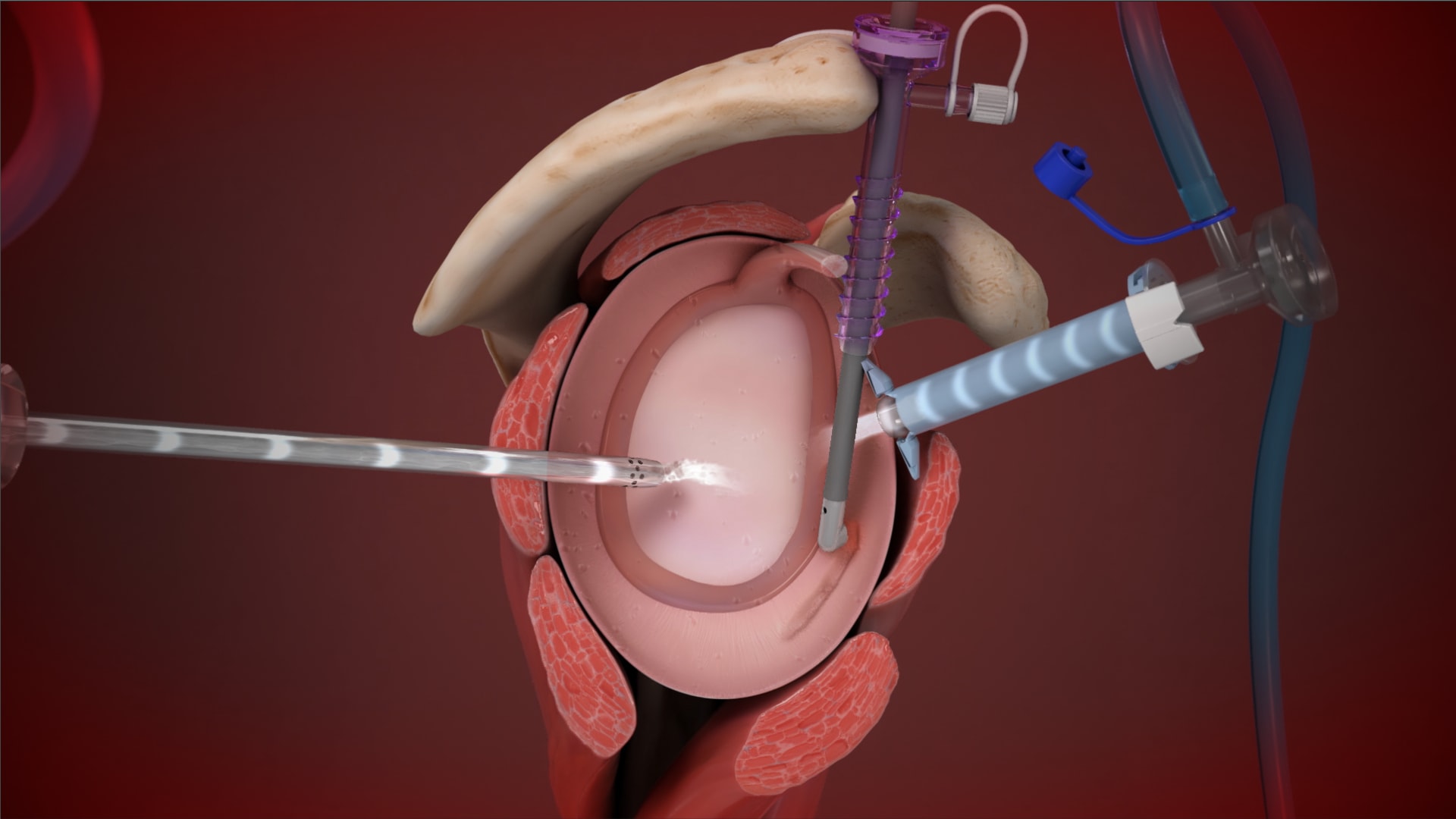 Benefits of Using the DualWave™ Arthroscopy Pump With ApolloRF® Probes