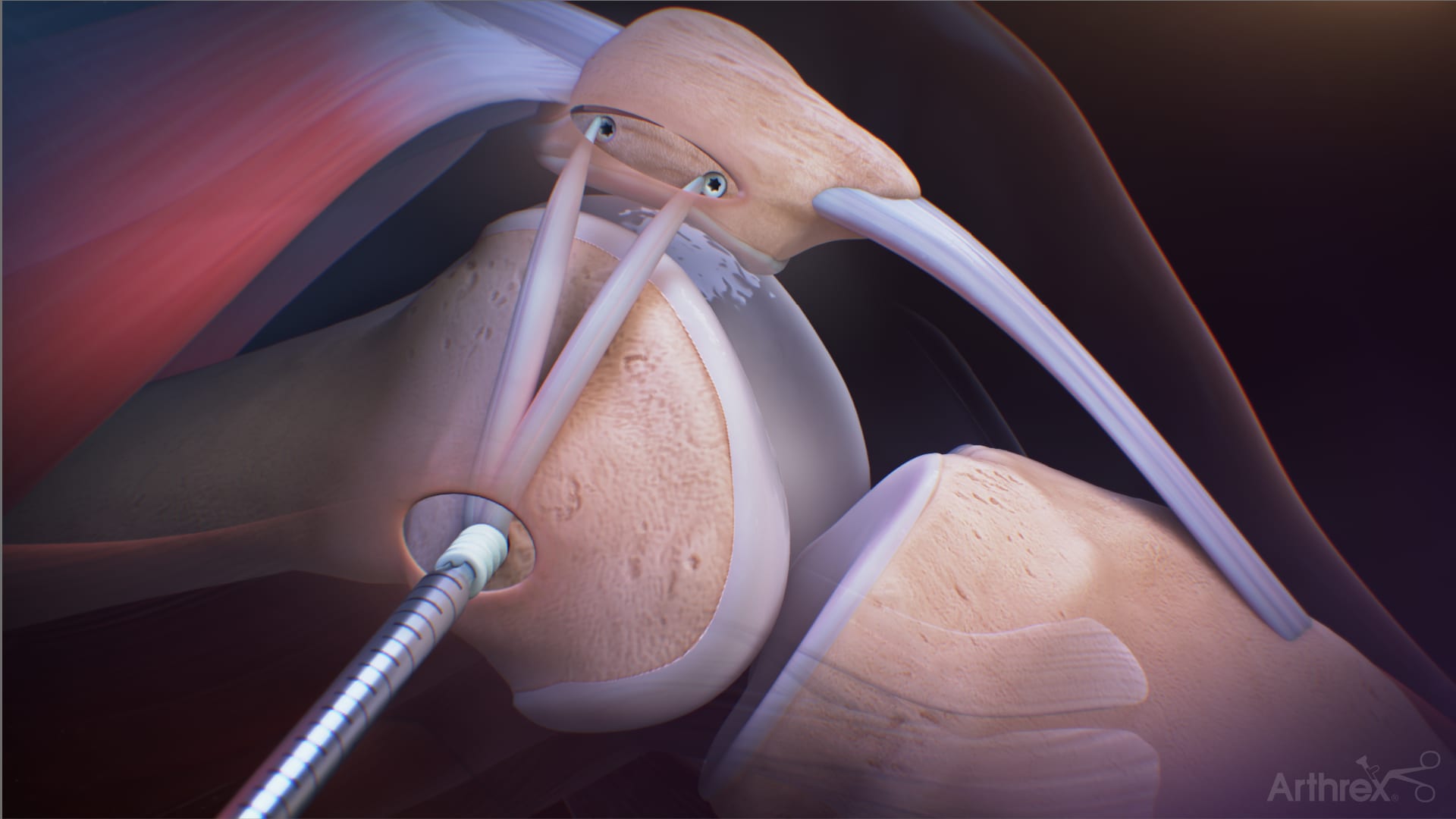 MPFL Reconstruction Using 3.9 mm BioComposite SwiveLock® Anchor and 6 mm × 20 mm BioComposite FastThread™ Interference Screw Kit