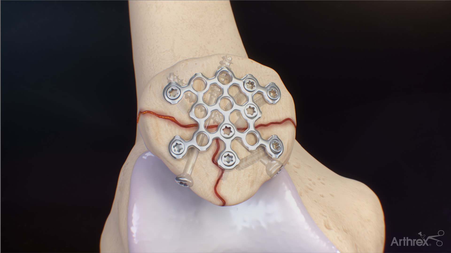 Arthrex Mesh Plate for Patella Fracture