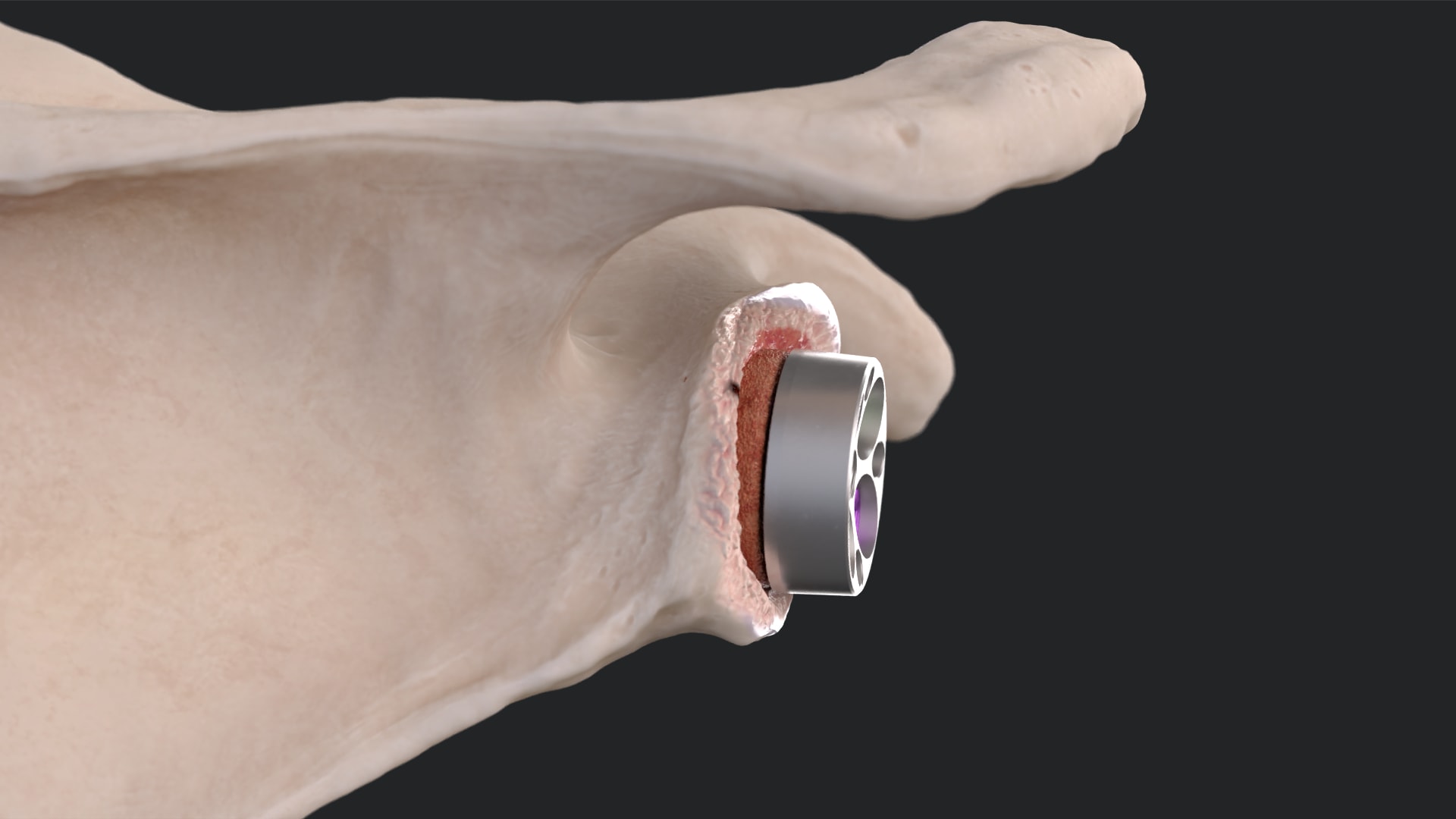 Bone Graft Preparation for Univers Revers™ Modular Glenoid System