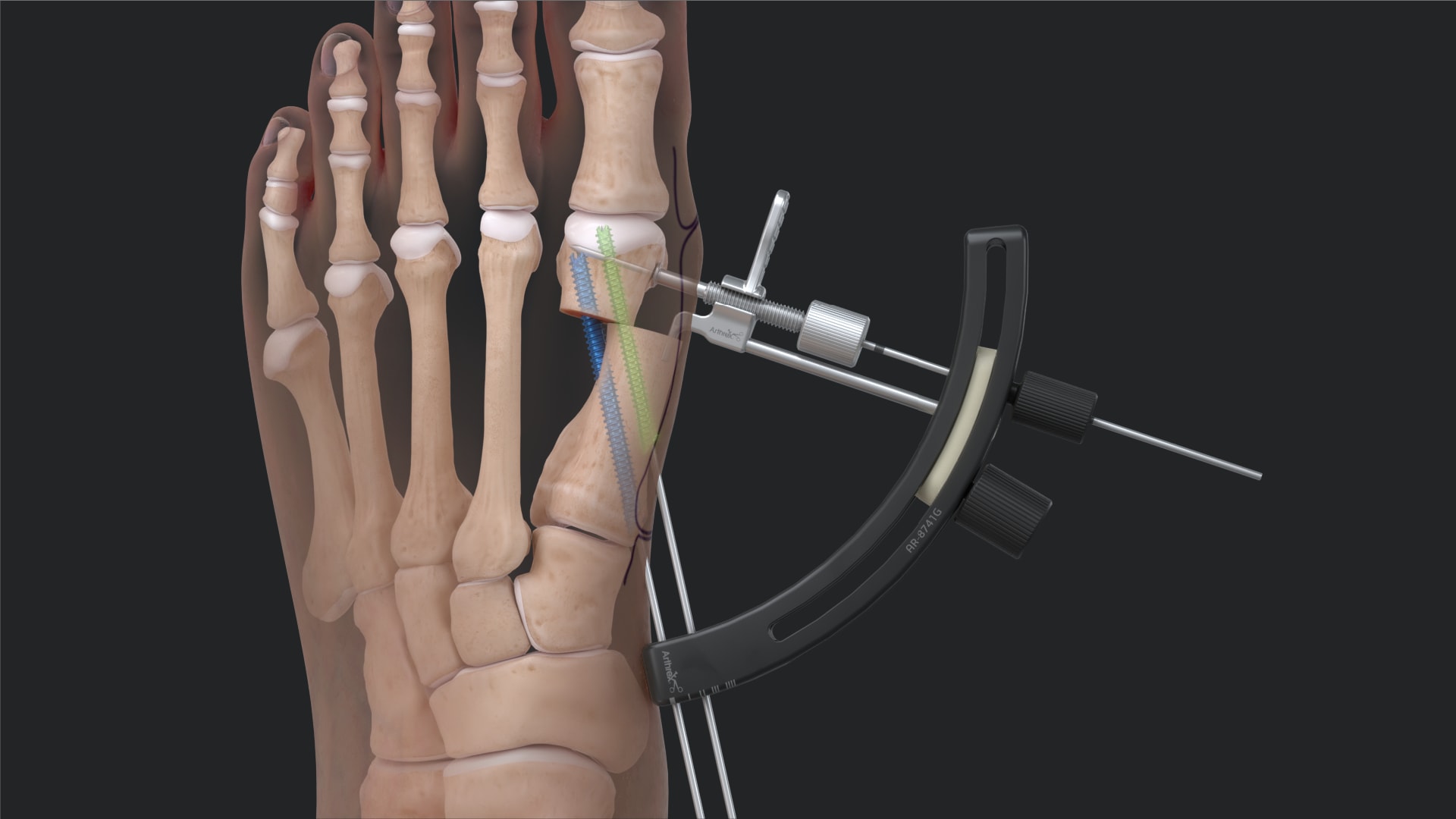 Arthrex Minimally Invasive Bunionectomy System Surgical Technique