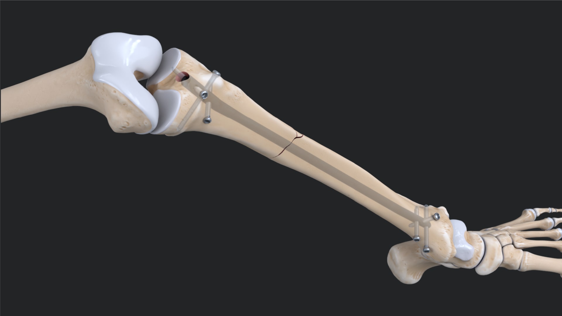 Tibial Nail System—Standard Surgical Technique