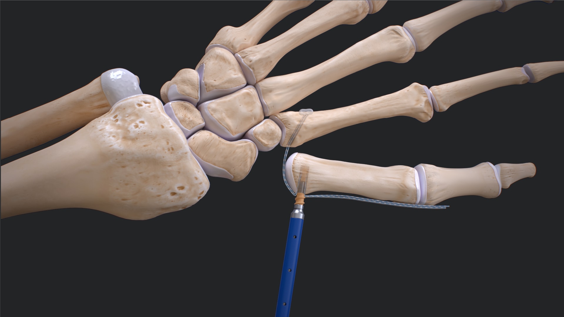 CMC Suspensionplasty Using the FiberLock™ Suspension System