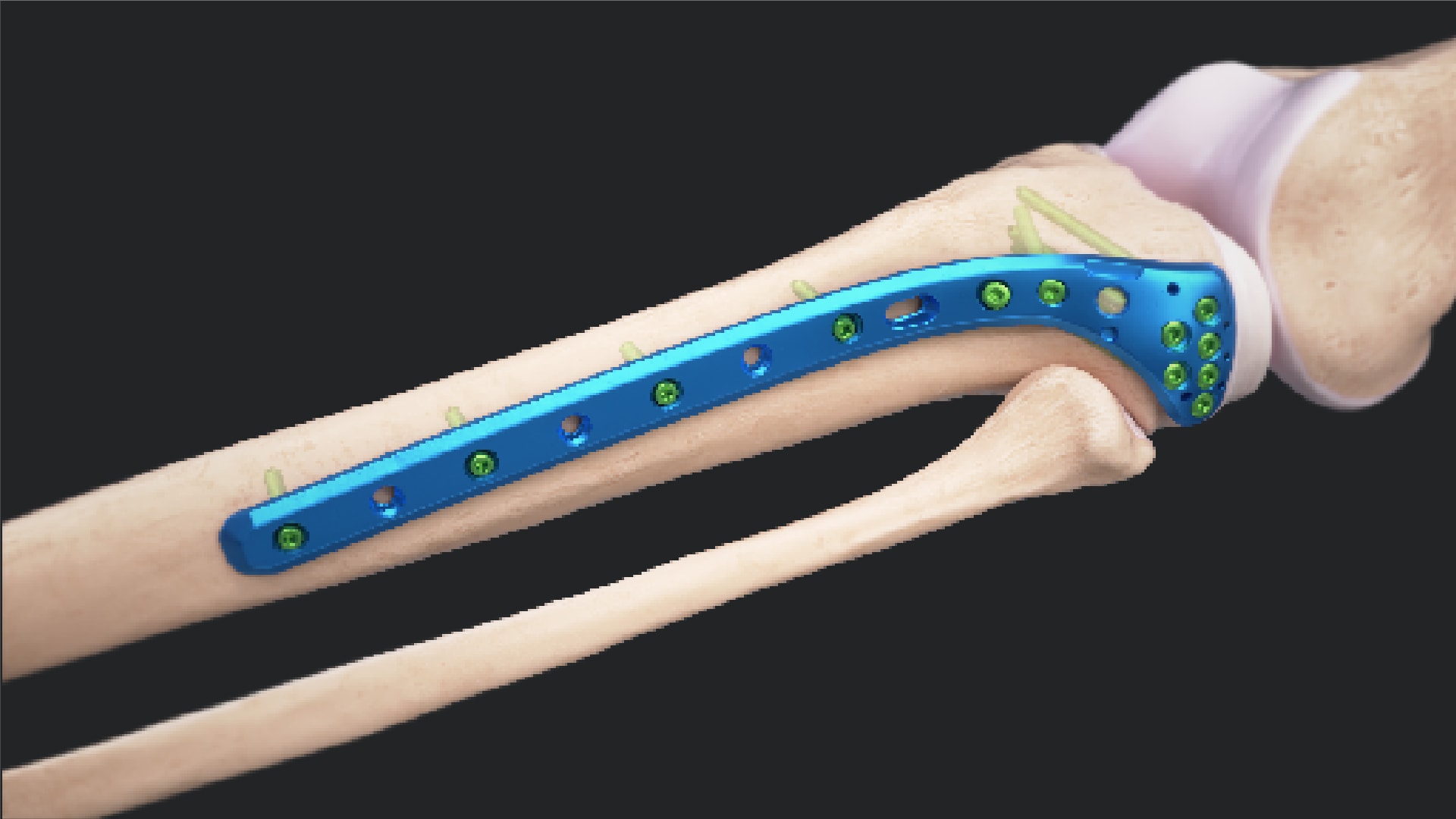 Titanium Proximal Tibia Plating System