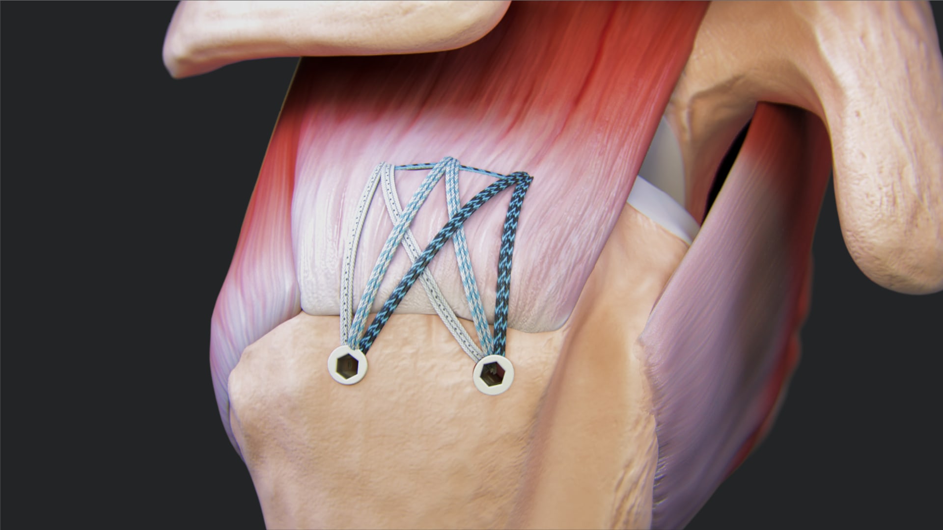 Knotless FiberTak® SpeedBridge™ Rotator Cuff Repair With Medial Pulley Ripstop