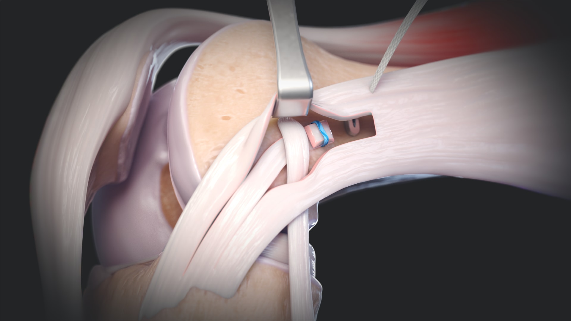 Iliotibial Band Tenodesis Using the FiberStaple™ Technique and Double Knotless Knee FiberTak® Anchor