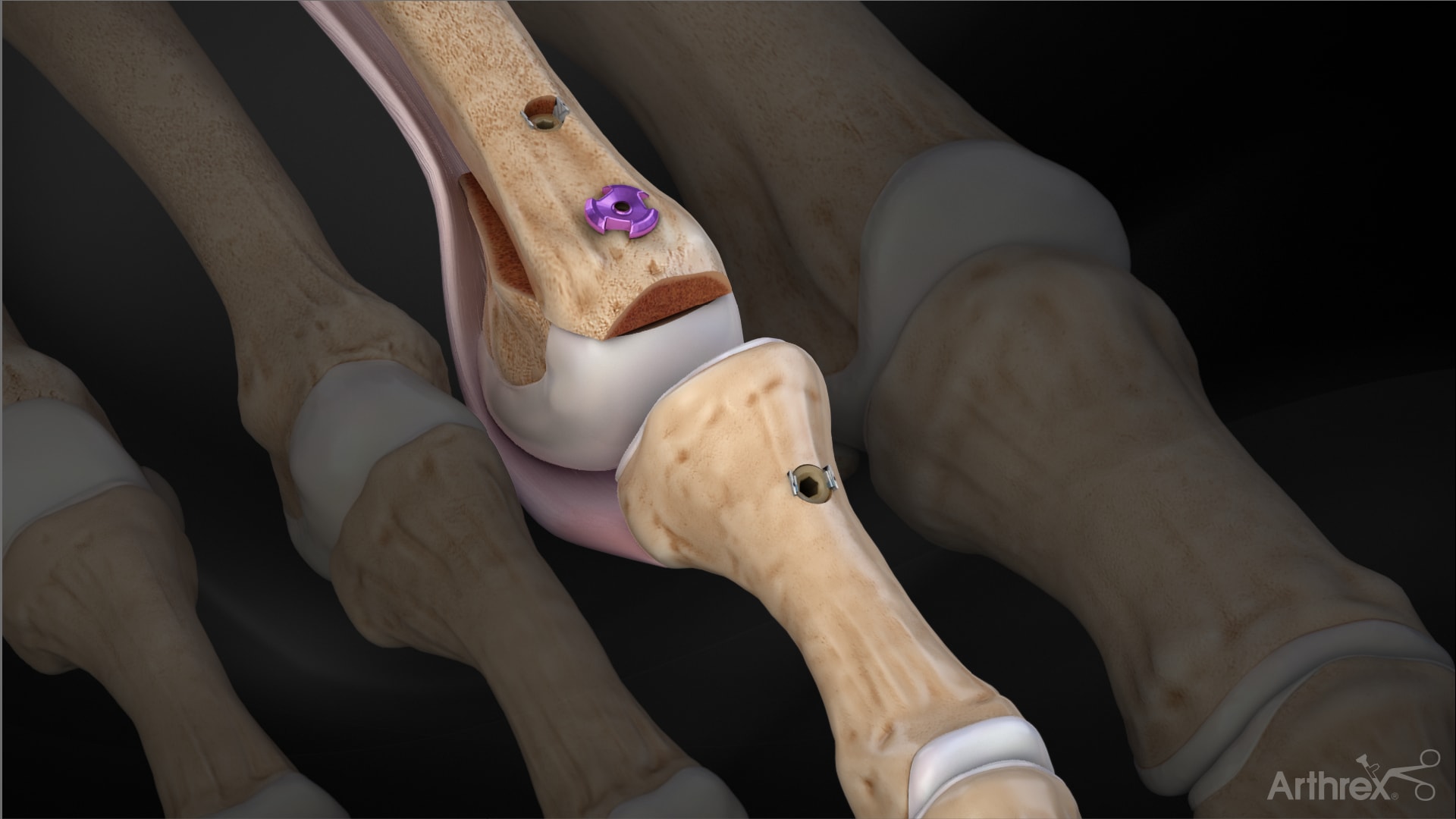 Plantar Plate InternalBrace™ Ligament Augmentation Surgical Technique