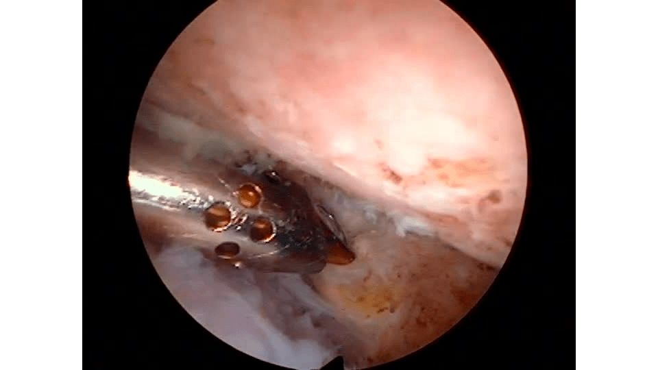 Revision Distal Clavicle Resection