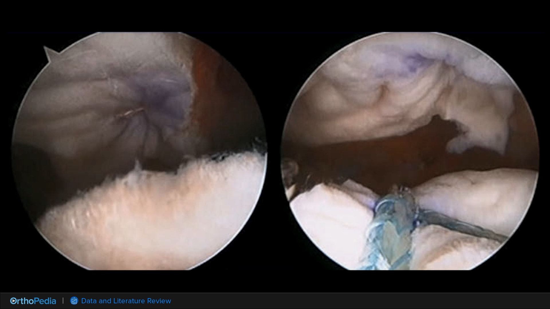 Rotator Cuff Tears: Literature Review of Biologic Rotator Cuff Augmentation