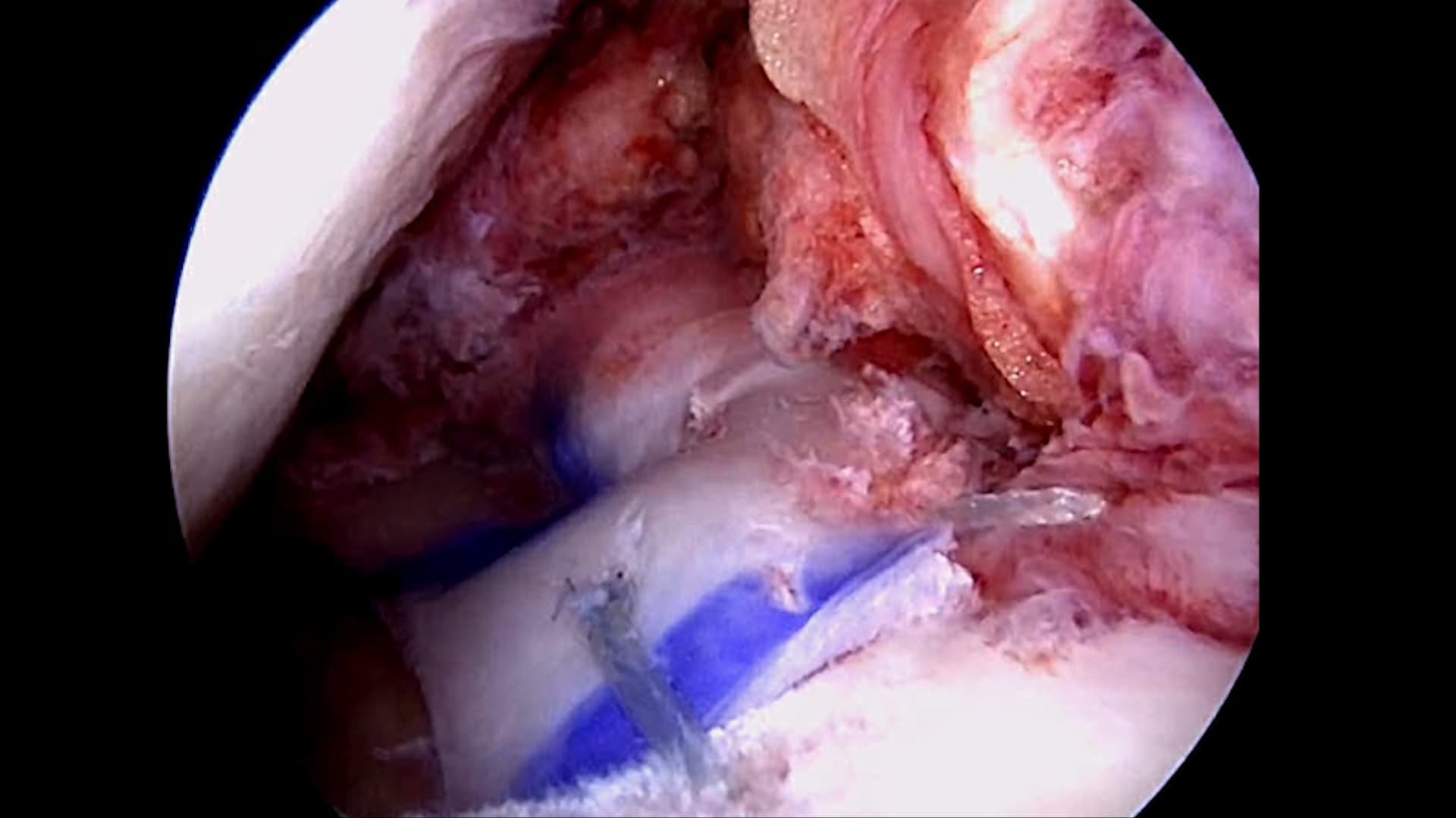 OTIF: Replacing the Meniscus