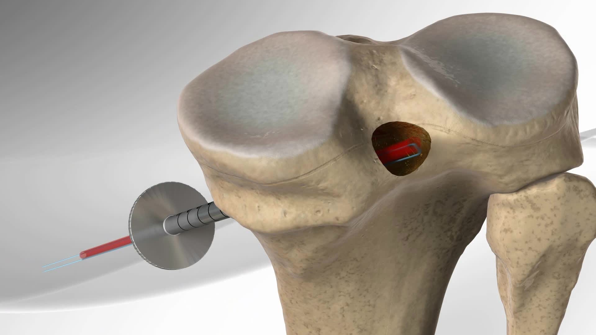 Inlay PCL Reconstruction with PCL TightRope® Technique