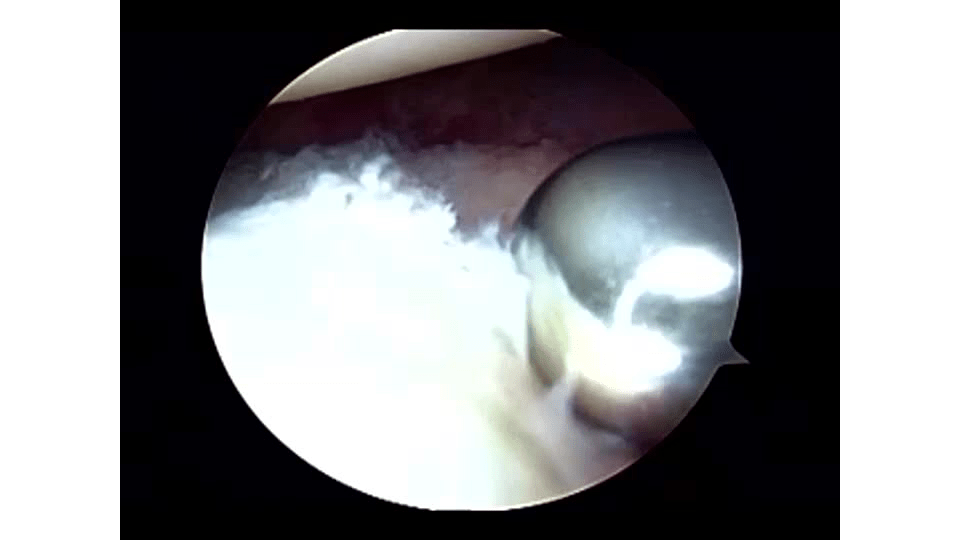 Arthroscopic Bankart with Posterior Plication