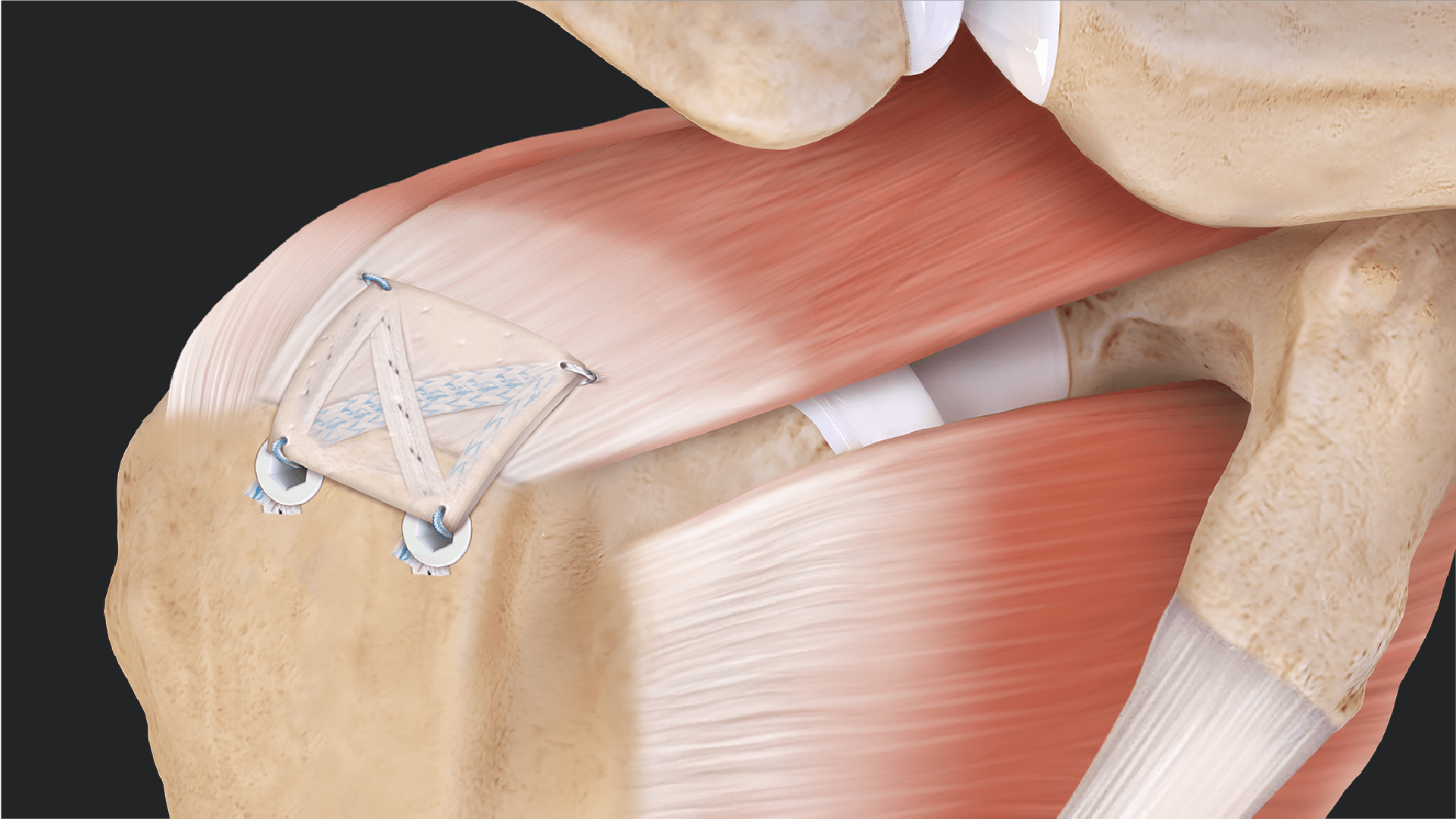 SpeedBridge™ Canopy Augmentation Technique With ArthroFLEX® Dermal Allograft