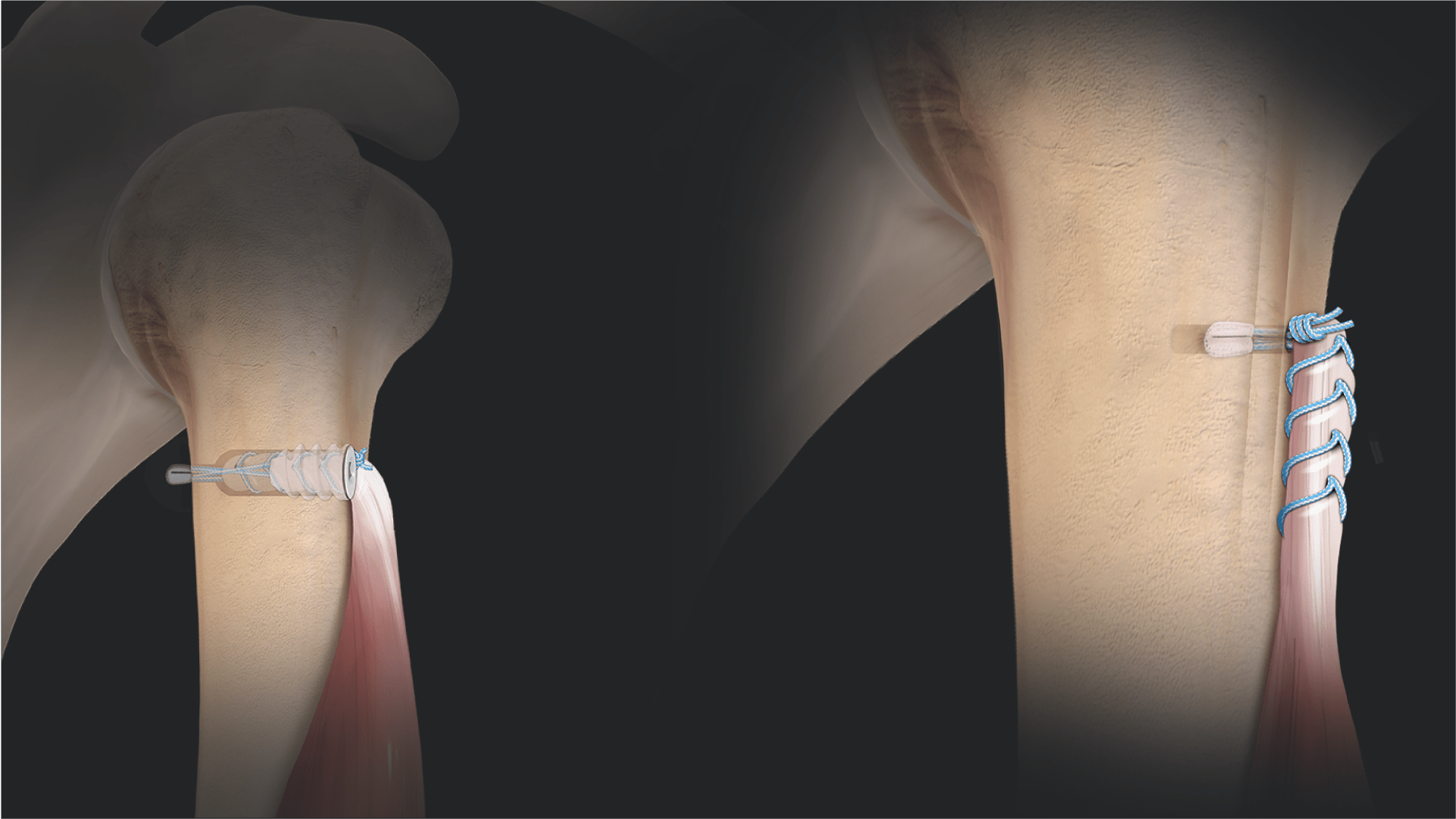 Subpectoral Biceps Tenodesis Using a FiberTak® Button