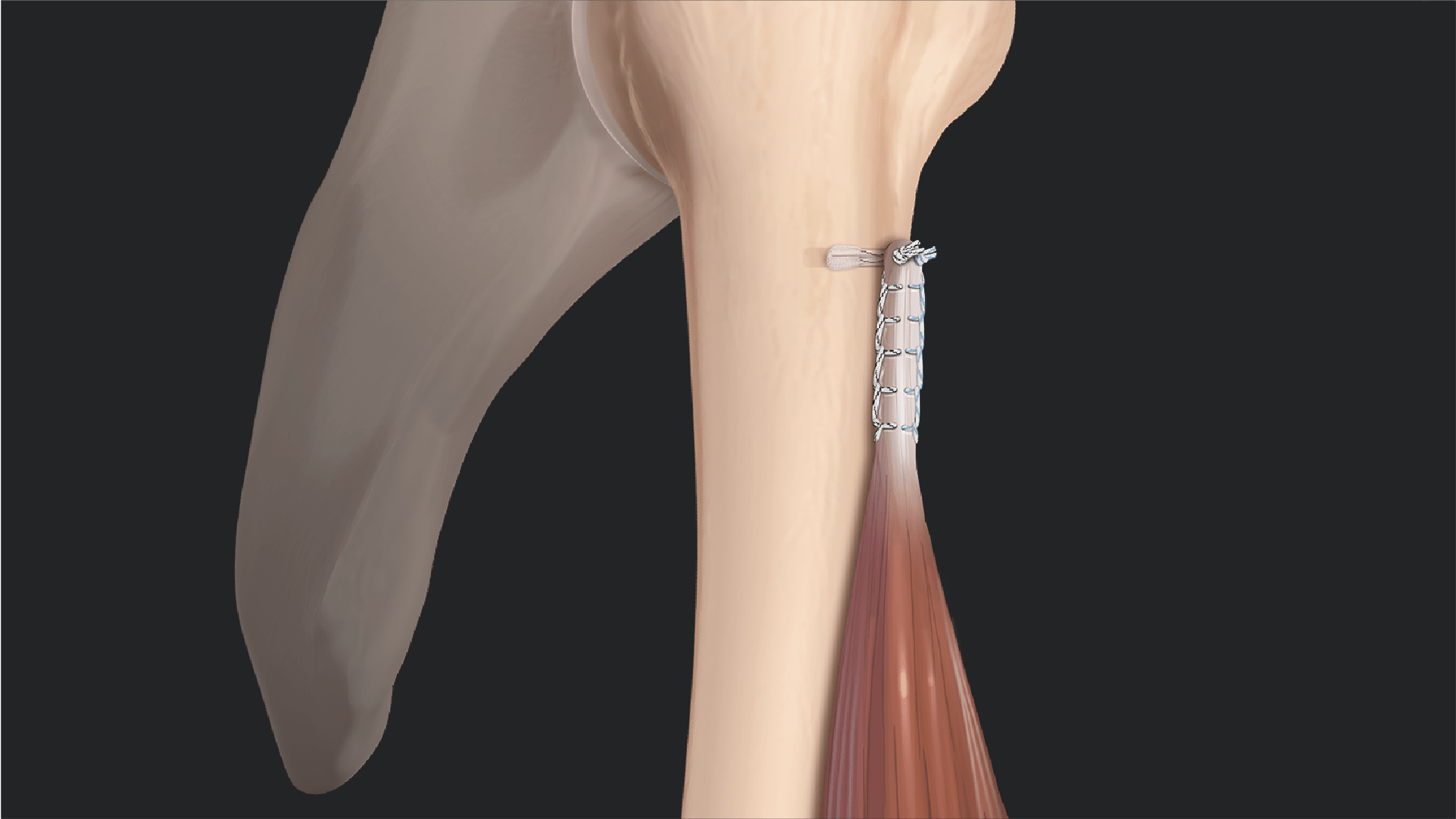 Biceps Tenotomy vs Tenodesis: Literature Review and Rationale for Tenodesis