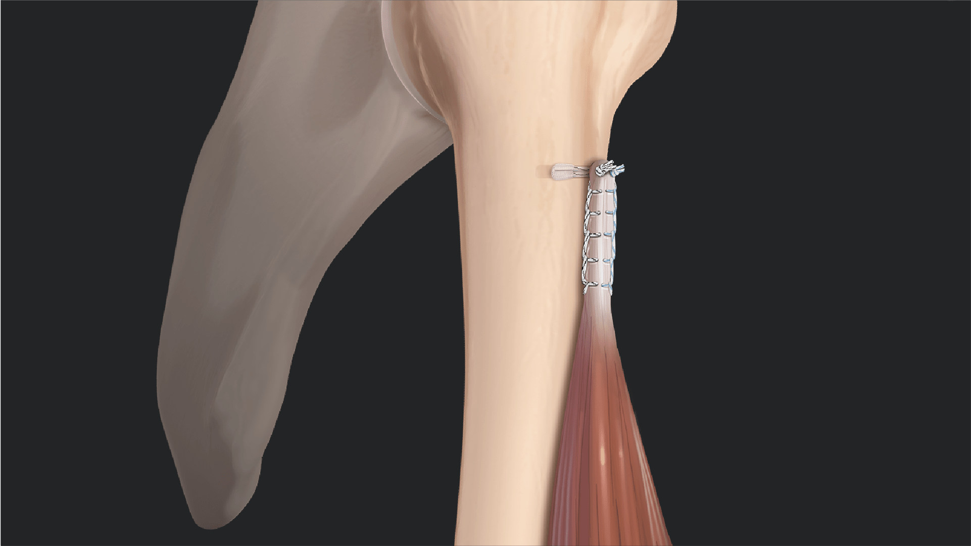 Arthrex - Biceps Tenotomy vs Tenodesis: Literature Review and Rationale ...