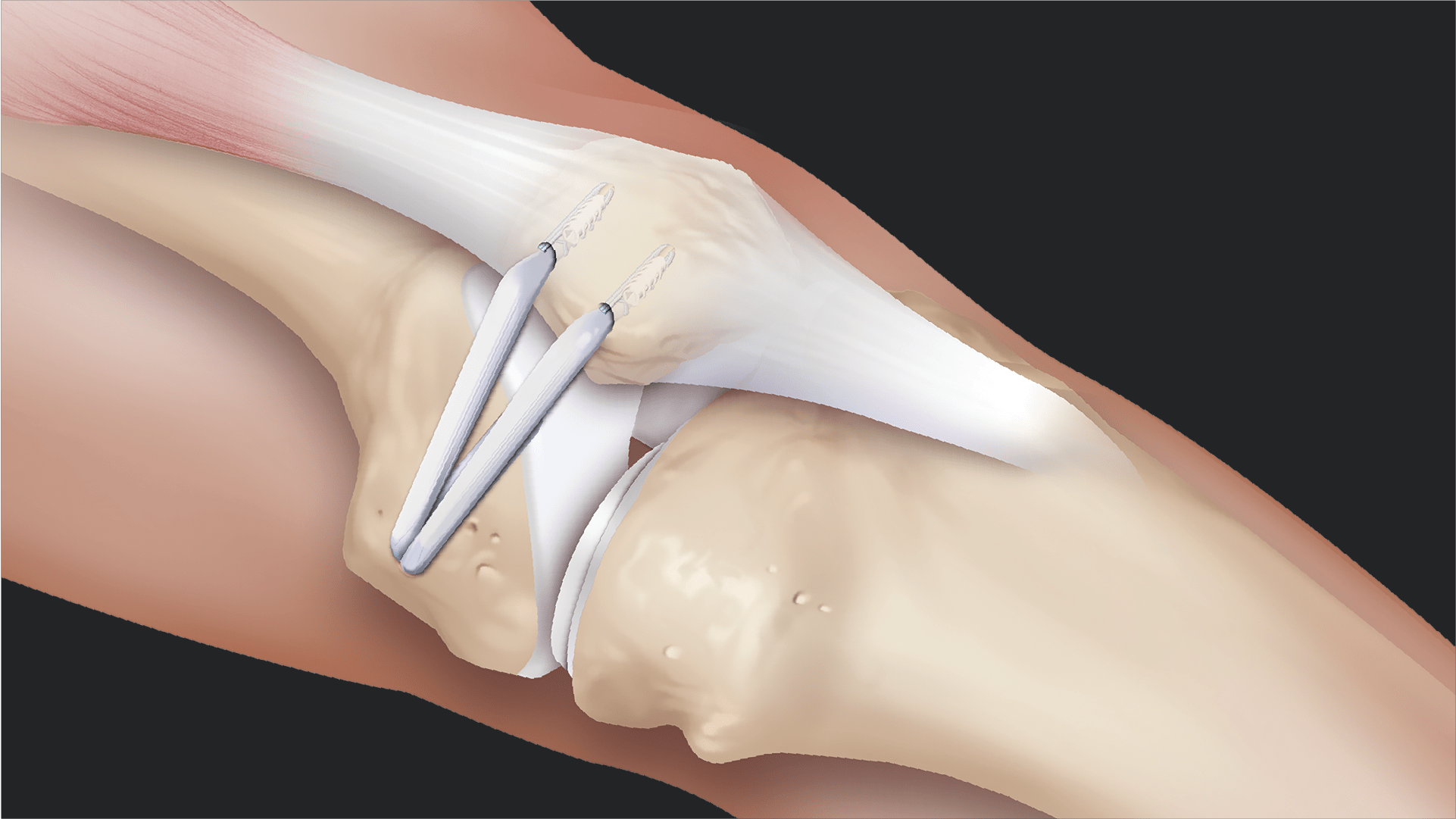 MPFL Reconstruction Using 3.9 mm BioComposite SwiveLock® Anchors and ACL TightRope® Implant