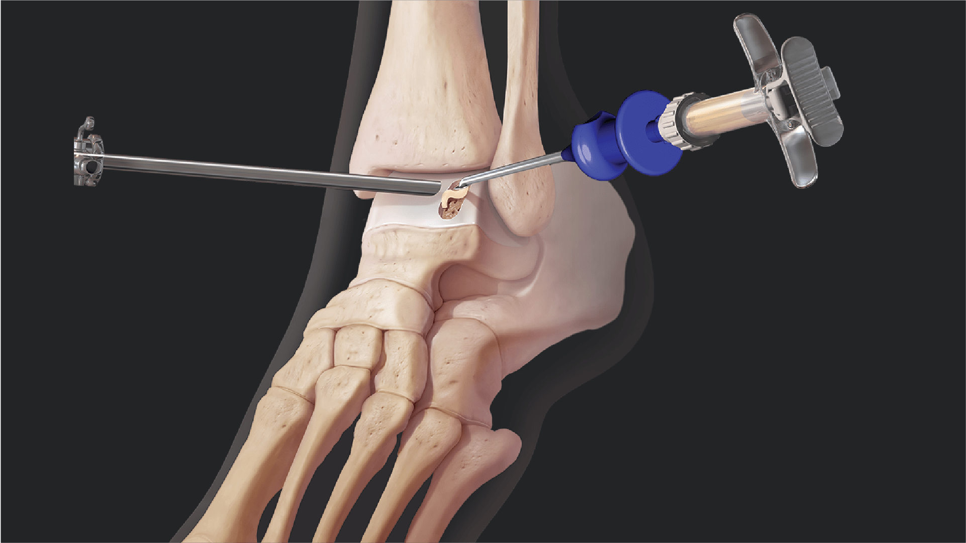 Outcomes for BioCartilage® Extracellular Matrix Versus Microfracture for Talar Osteochondral Lesions