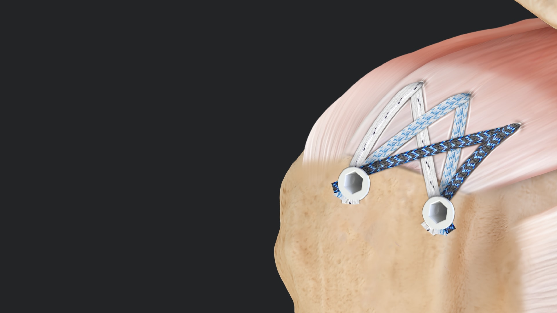 FiberTak® SpeedBridge™ Rotator Cuff Repair