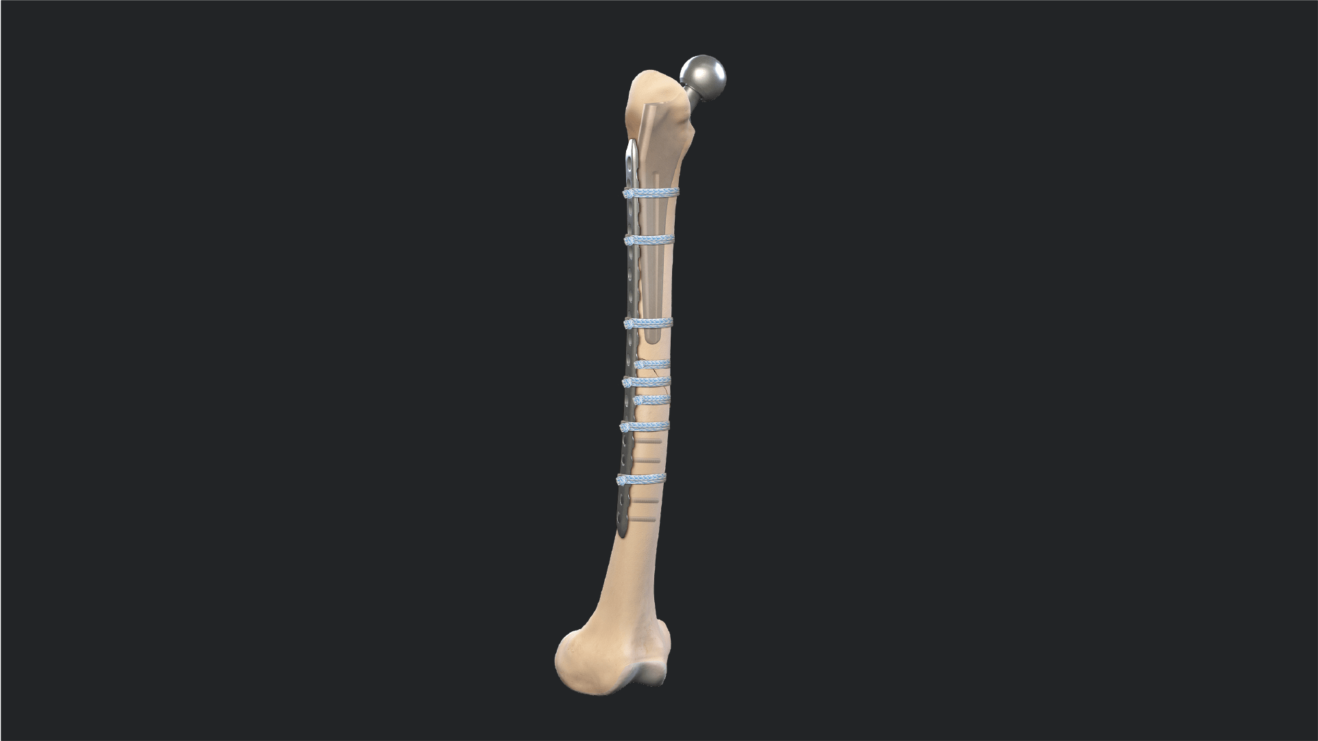 FiberTape® Cerclage Fixation of Periprosthetic Hip Fractures