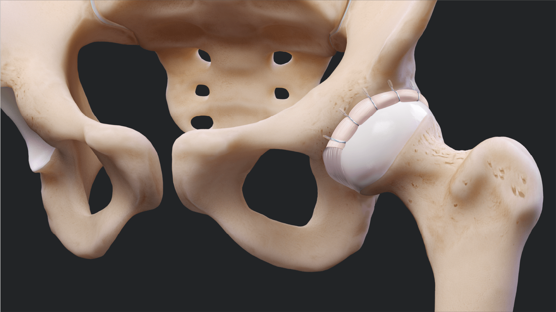 Labral Reconstruction Using Knotless FiberTak® Soft Anchors