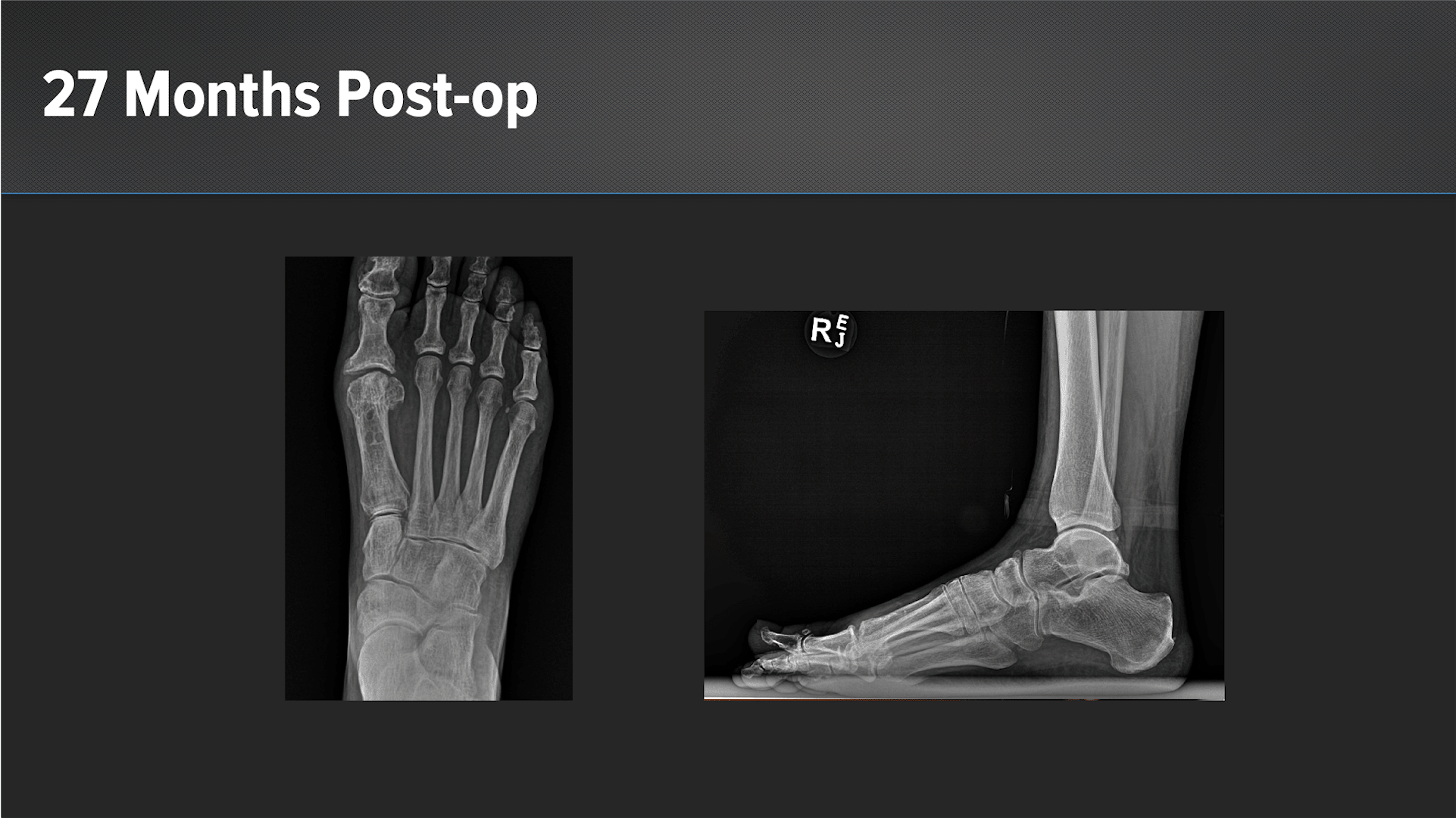 Hallux Rigidus Treatment With ArthroFLEX® Dermal Allograft