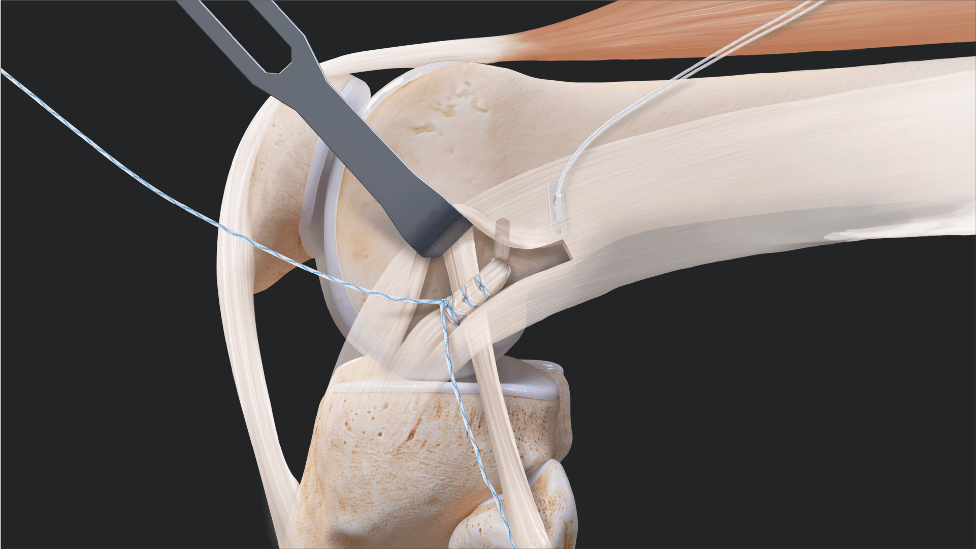 LET Using the FiberStaple™ Technique With the Self-Punching 2.6 Knotless FiberTak® Anchor