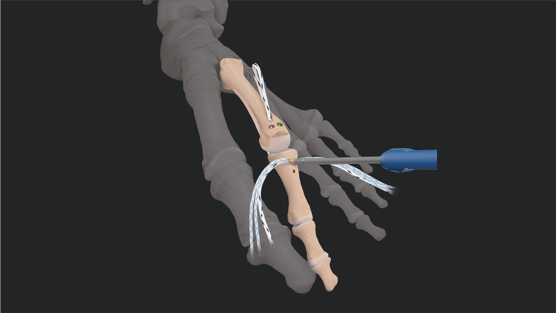 Simplifying the Plantar Plate Repair