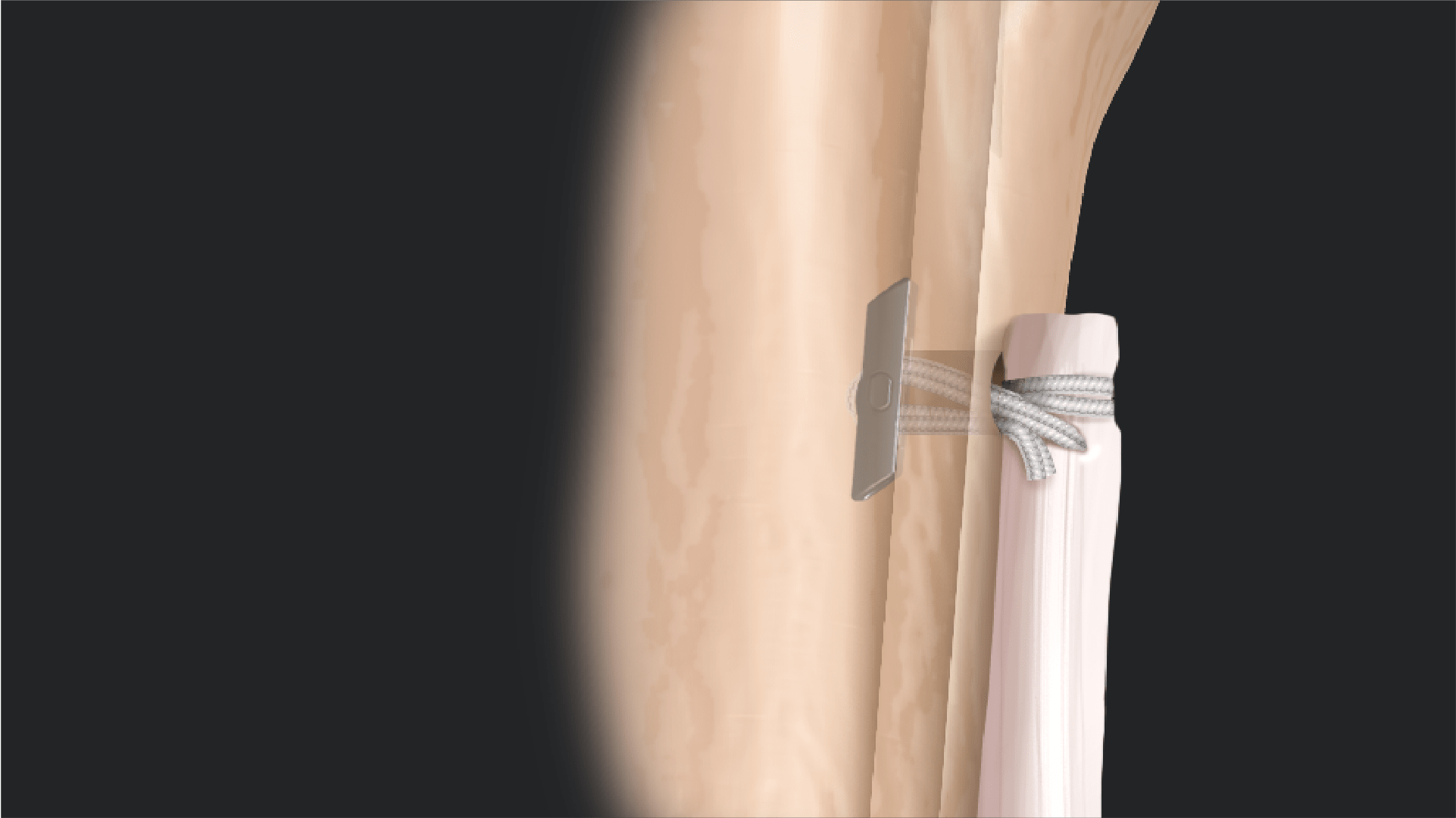 Arthrex - Knotless TensionTight-Button
