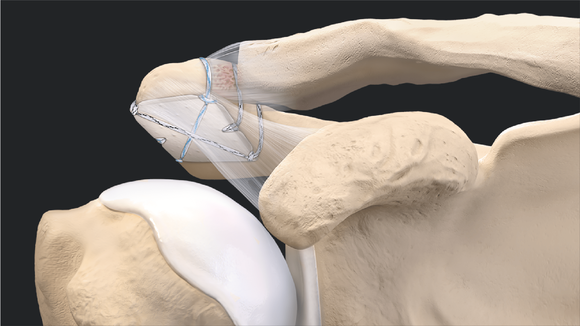 Bursal Acromial Reconstruction Case Presentation