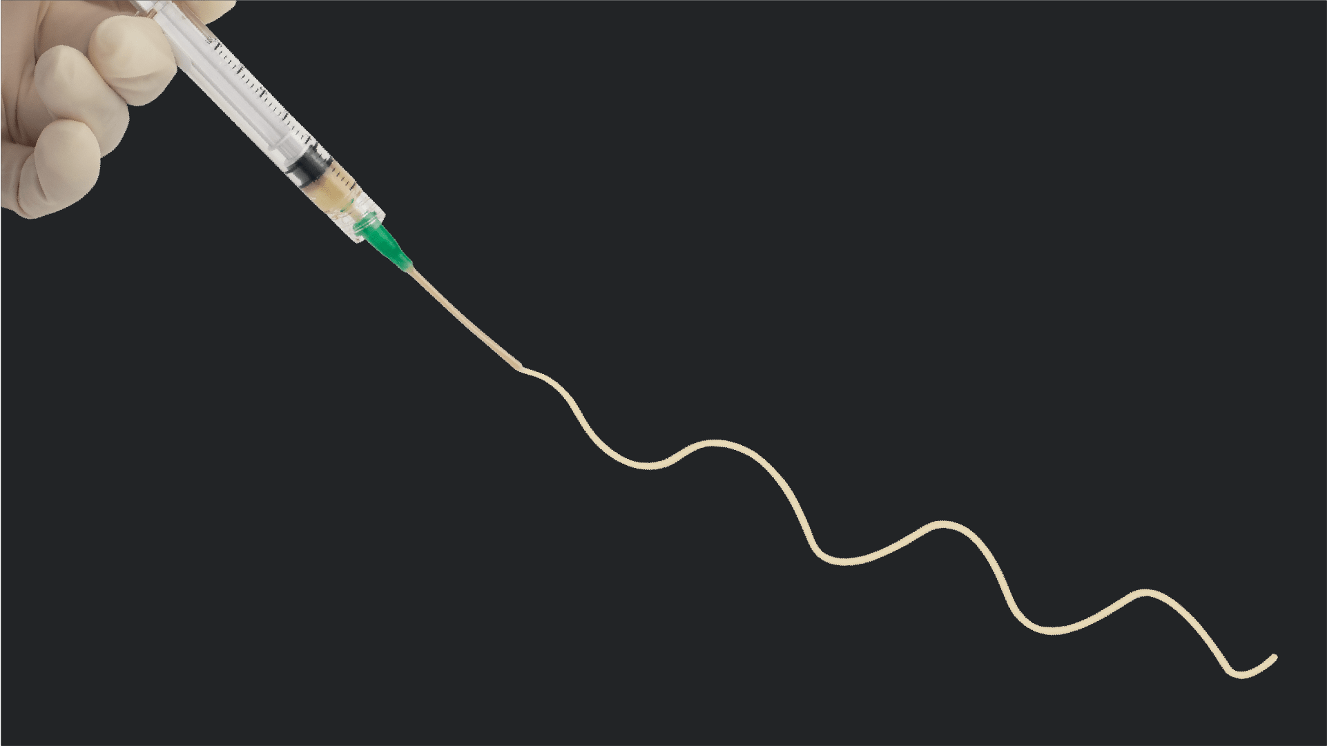 Interfyl® Connective Tissue Matrix for a Complex Case of Insertional Calcific Tendinosis