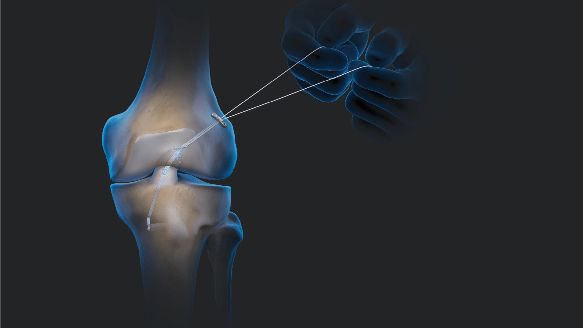 ACL Primary Repair Using the ACL Repair TightRope® Implant and FiberRing™ Sutures